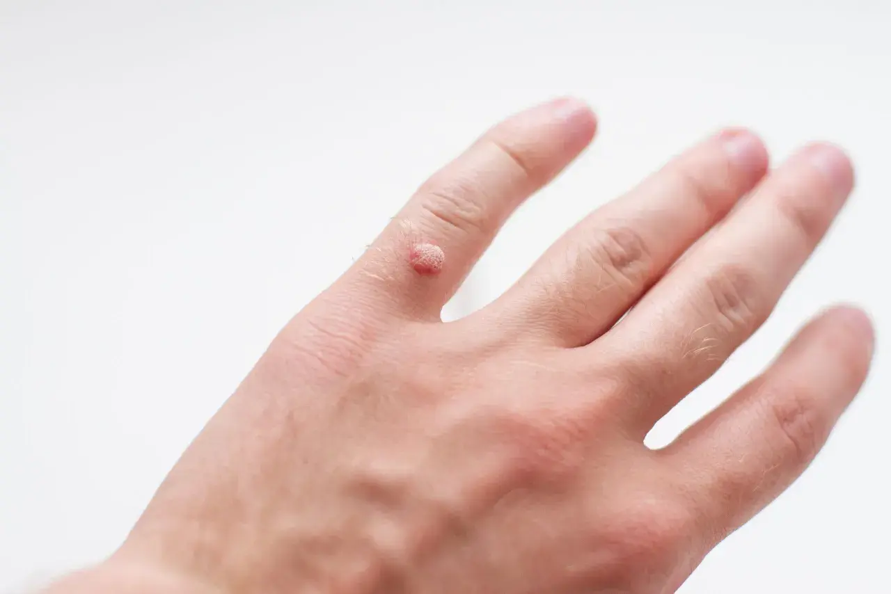 Czy można zarazić się kurzajką? Poznaj prawdę o infekcji HPV