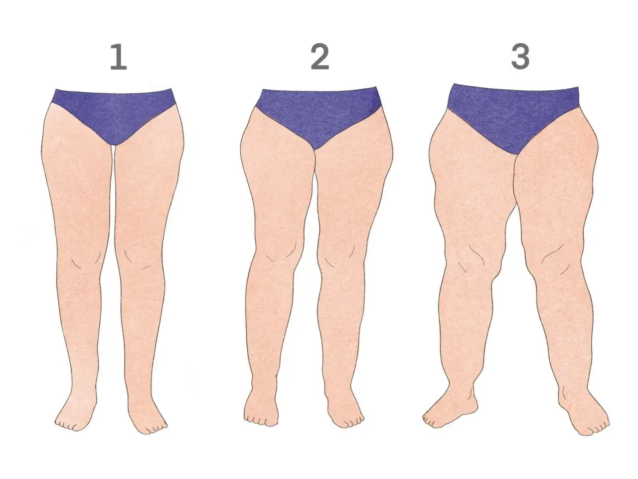 Ilustracja przedstawiająca nogi kobiet z różnym stopniem lipodemi.