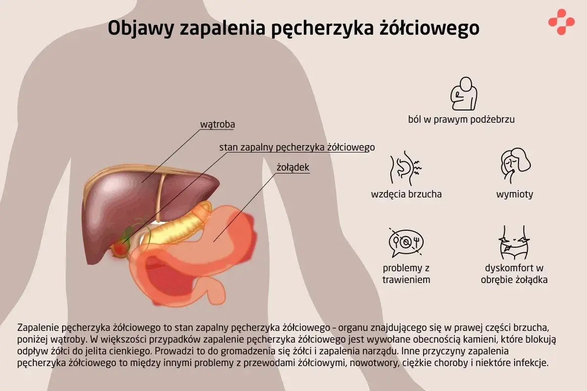 Ilustracja anatomiczna przedstawiająca wątrobę, żołądek i pęcherzyk żółciowy z objawami zapalenia.