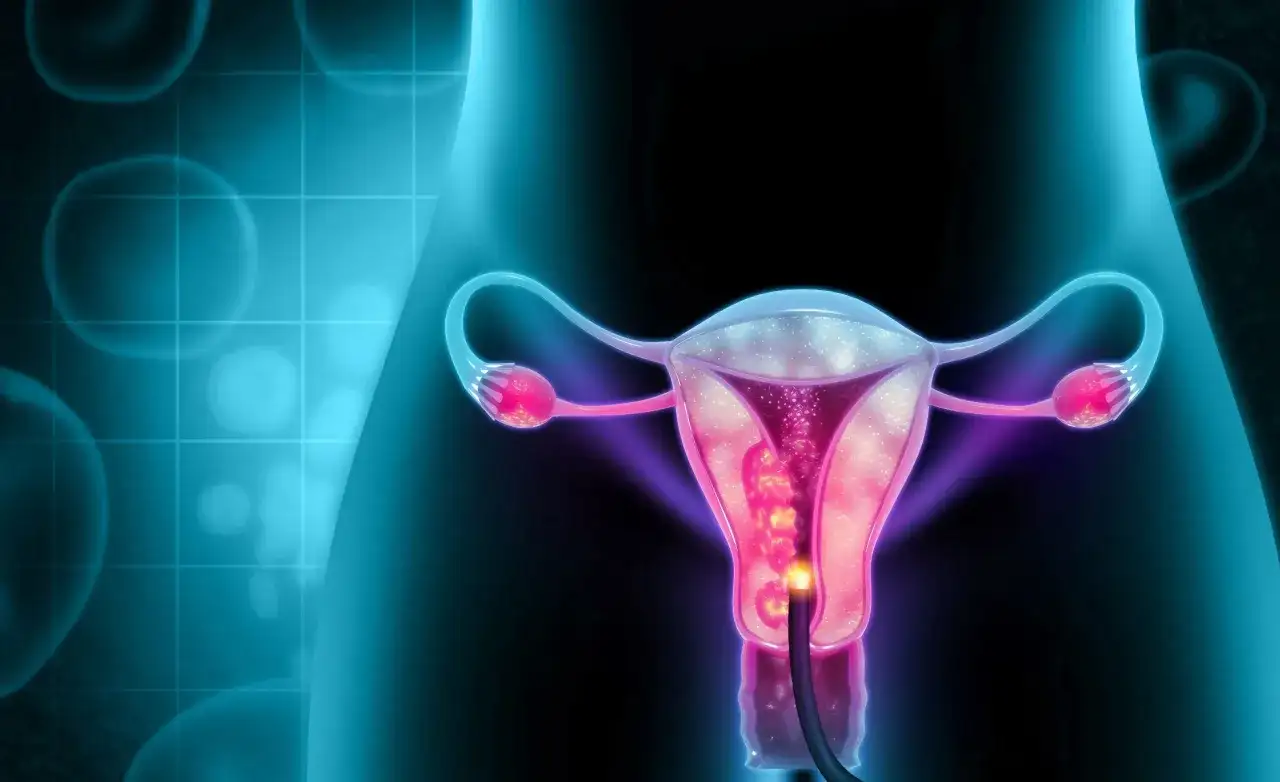 Ilustracja przedstawia macicę z widocznym polipem endometrialnym, do którego wprowadzono endoskop.
