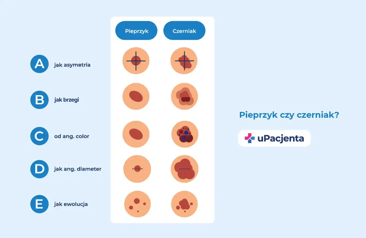 Porównanie znamion: łagodne pieprzyki vs. potencjalnie groźne czerniaki. Ilustracje pokazują różnice w asymetrii, brzegach, kolorze, średnicy i ewolucji.