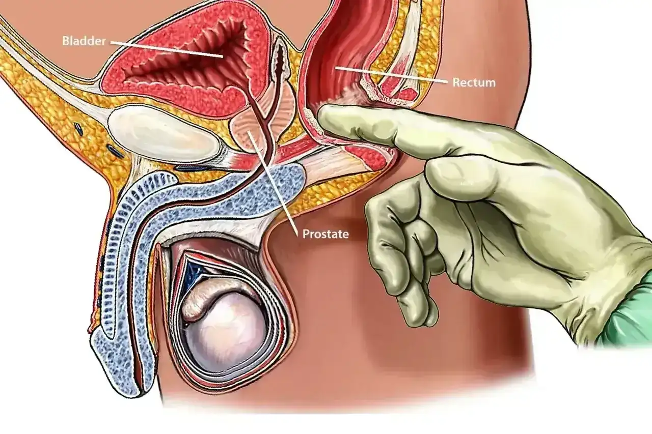 Ilustracja przedstawia badanie per rectum, które jest częścią diagnostyki raka prostaty. Dłoń w rękawiczce bada gruczoł krokowy.