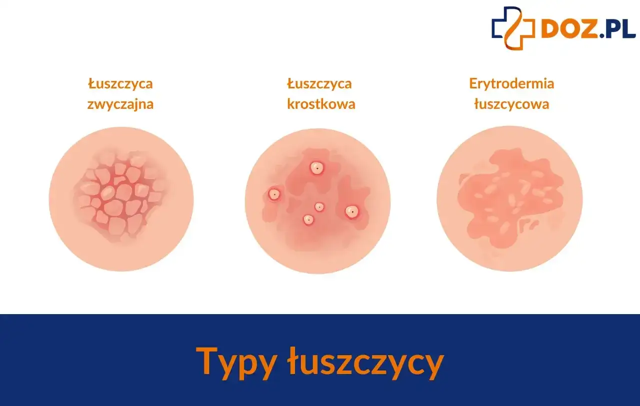 Ilustracje pokazują różne typy łuszczycy: łuszczycę zwyczajną, krostkową i erytrodermię łuszczycową.