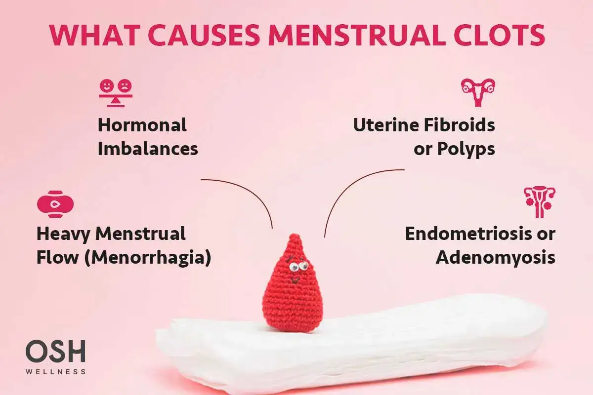 Przyczyny skrzepów podczas okresu: zaburzenia hormonalne, obfite krwawienia, mięśniaki, polipy, endometrioza.