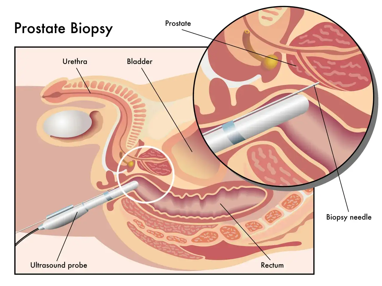 Ilustracja przedstawia biopsję prostaty. Igła biopsyjna pobiera próbkę tkanki z prostaty, wspomagana przez sondę ultradźwiękową.