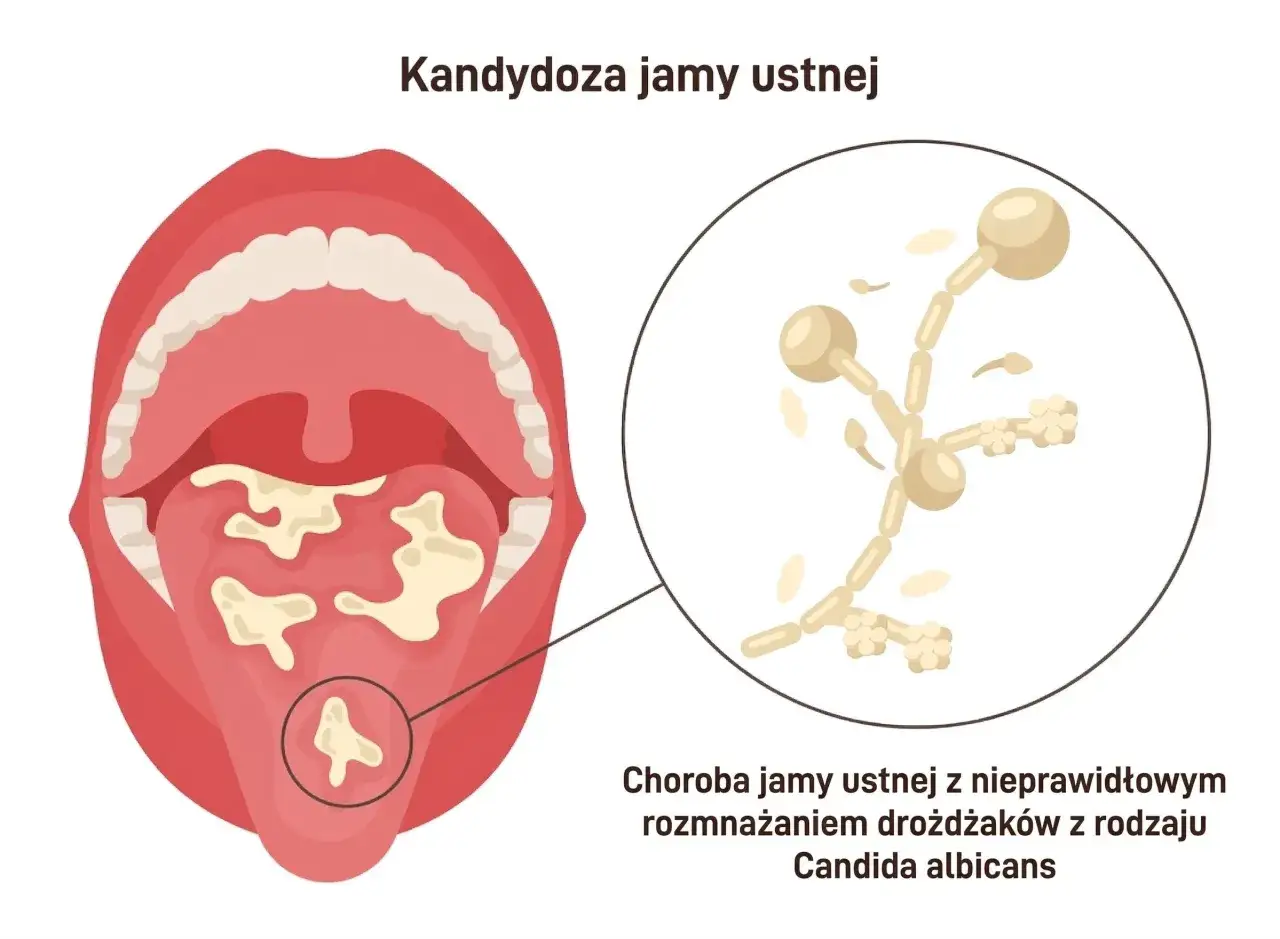 Kandydoza jamy ustnej: białe naloty na języku i podniebieniu, powiększenie drożdżaków Candida.