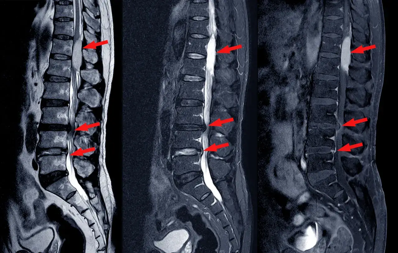 MRI kręgosłupa lędźwiowego z widocznymi zmianami zapalnymi krążka międzykręgowego, wskazującymi na zapalenie krążka międzykręgowego objawy.
