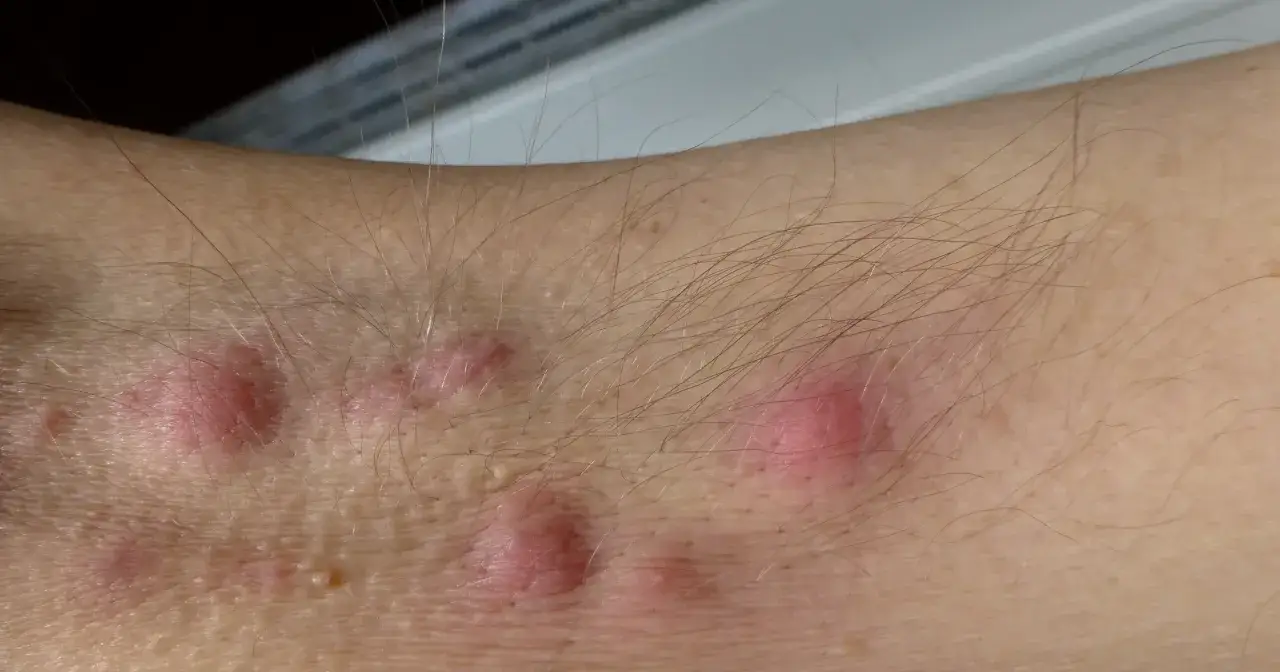 Skóra z kilkoma czerwonymi, bolesnymi zmianami, które mogą wskazywać na trądzik odwrócony. Widać włosy i drobne krostki.