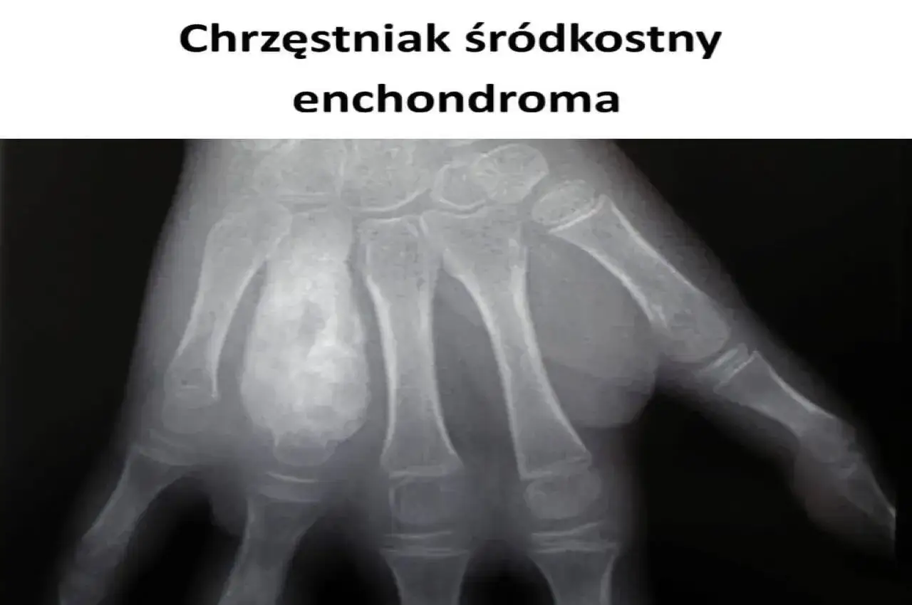 Rentgen dłoni z widocznym chrząstniakiem śródkostnym w kości śródręcza.