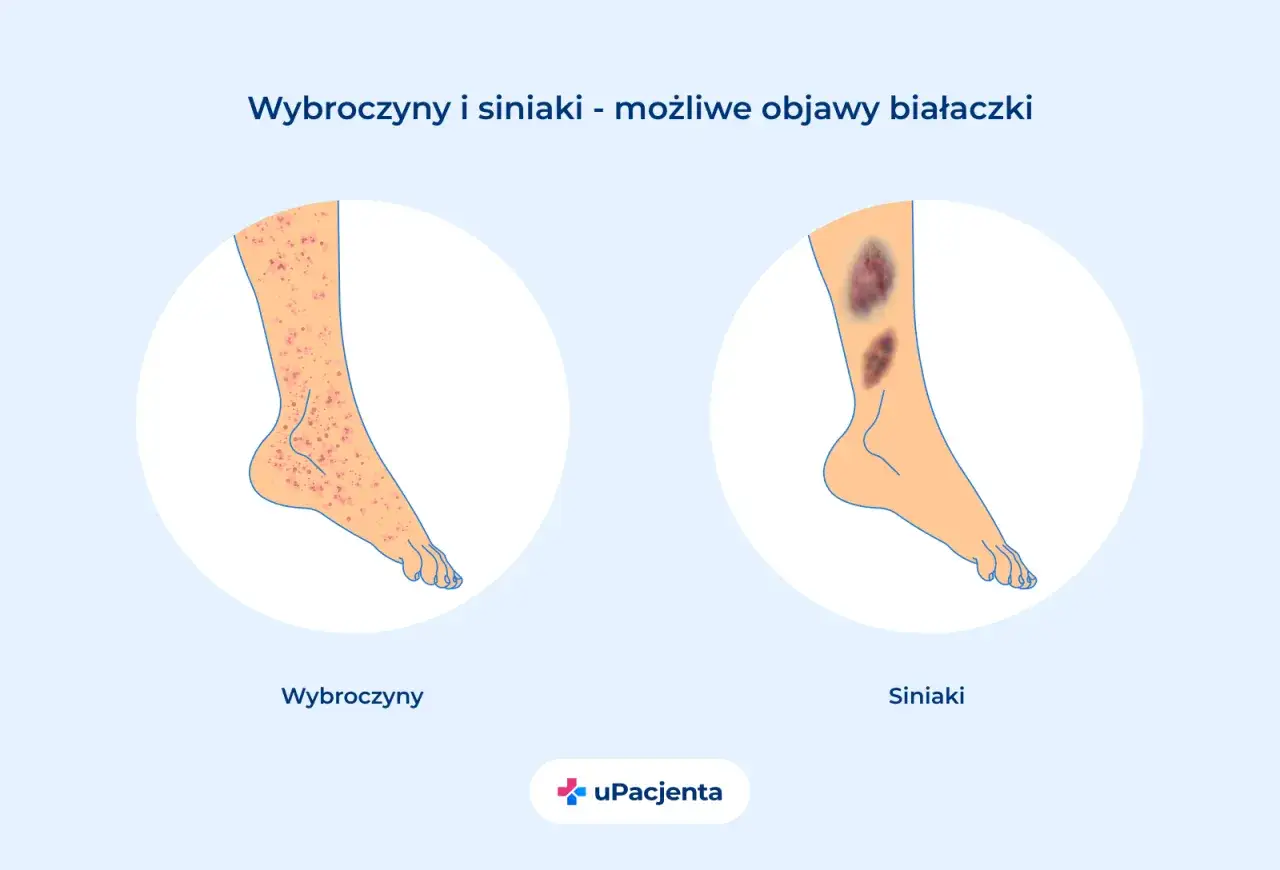 Wybroczyny i siniaki na nogach mogą być objawem białaczki. Ilustracja pokazuje nogę z licznymi czerwonymi plamkami (wybroczyny) i drugą nogę z ciemnymi siniakami.