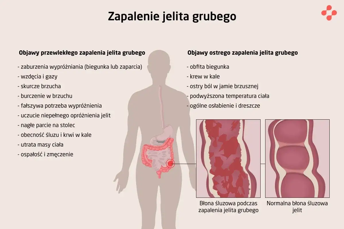 Ilustracja przedstawia objawy zapalenia jelita grubego, w tym bóle brzucha, biegunkę, krew w kale i osłabienie. Widoczna jest też błona śluzowa jelita podczas zapalenia i zdrowa.