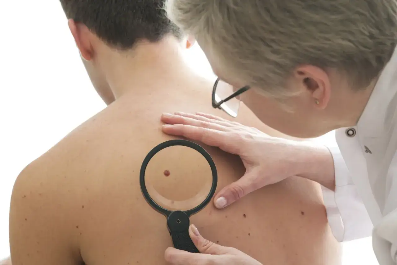 Dermatolog bada plecy pacjenta, używając lupy do oceny pieprzyków, w tym jednego, który może być niebezpieczny.