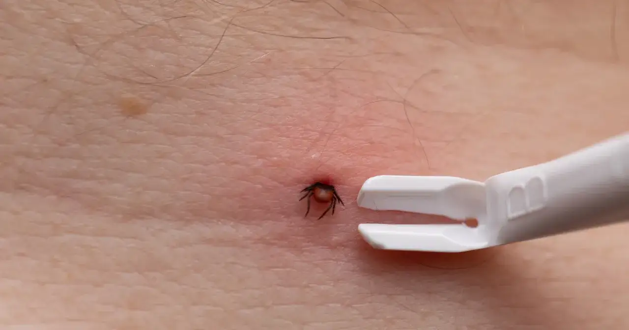 Zbliżenie na skórę z zaczerwienieniem i wbitym kleszczem, obok którego znajduje się białe narzędzie do usuwania pasożytów.