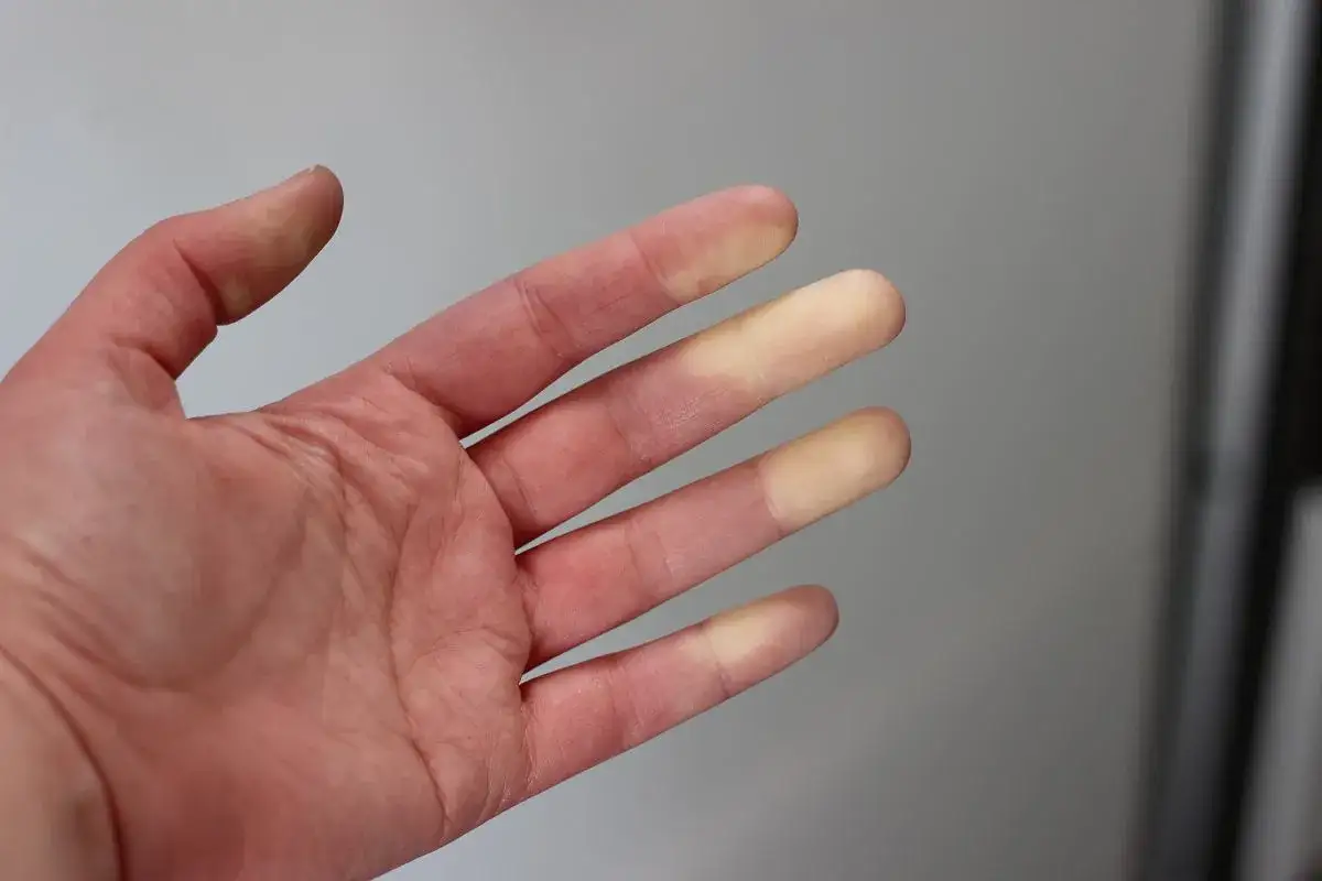 Dłoń z palcami, których końcówki są blade, co jest objawem Raynauda.