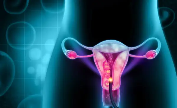 Ilustracja przedstawia macicę z widocznym polipem endometrialnym, do którego wprowadzono endoskop.