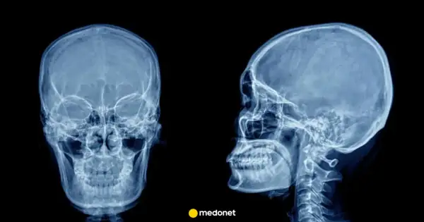 RTG czaszki z przodu i z profilu. Obraz może sugerować rozległy udar mózgu, wymagający pilnej diagnostyki.
