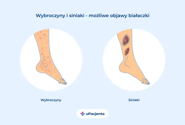 Wybroczyny i siniaki na nogach mogą być objawem białaczki. Ilustracja pokazuje nogę z licznymi czerwonymi plamkami (wybroczyny) i drugą nogę z dużymi, ciemnymi siniakami.