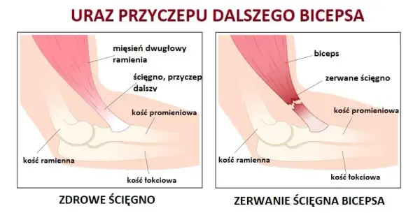 Naderwany biceps: 5 kluczowych objawów, które musisz znać