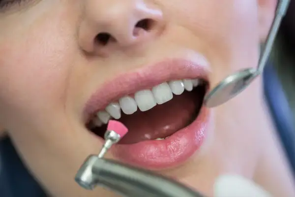 Zbliżenie na usta kobiety podczas zabiegu fluoryzacji zębów z użyciem szczoteczki i lusterka dentystycznego.