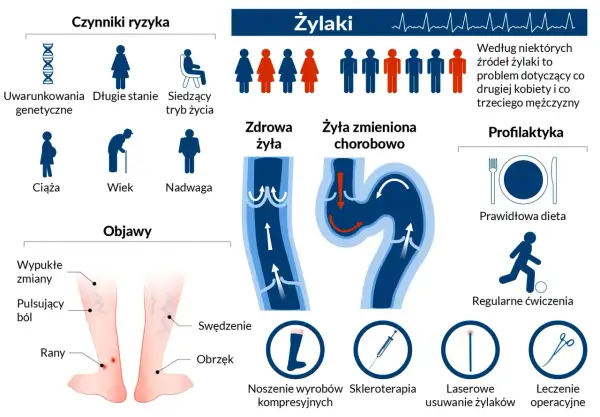 Grafika przedstawia żylaki, ich objawy, czynniki ryzyka (genetyka, ciąża, wiek, nadwaga, długie stanie, siedzący tryb życia) oraz profilaktykę (dieta, ćwiczenia, wyroby kompresyjne, skleroterapia, laser, operacja).