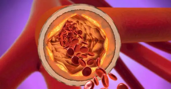 Przekrój tętnicy z widocznymi złogami cholesterolu i czerwonymi krwinkami.