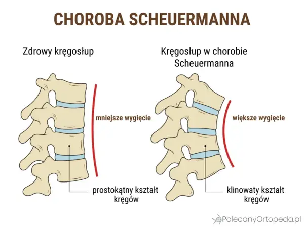 Porównanie zdrowego kręgosłupa z kręgosłupem w chorobie Scheuermanna. W chorobie Scheuermanna kręgi przybierają klinowaty kształt, co powoduje większe wygięcie kręgosłupa.