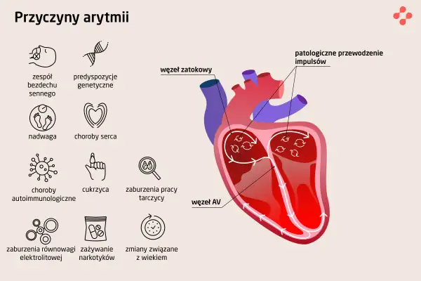 Ilustracja przedstawia przyczyny arytmii serca: bezdech senny, predyspozycje genetyczne, nadwagę, choroby serca, choroby autoimmunologiczne, cukrzycę, zaburzenia pracy tarczycy, zaburzenia elektrolitowe, narkotyki i wiek.
