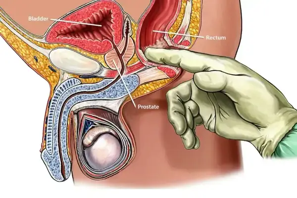 Ilustracja przedstawia badanie per rectum, które jest częścią diagnostyki raka prostaty. Dłoń w rękawiczce bada gruczoł krokowy.