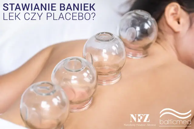 Szklane bańki na plecach pacjenta. Stawianie baniek - czy to lek, czy placebo?
